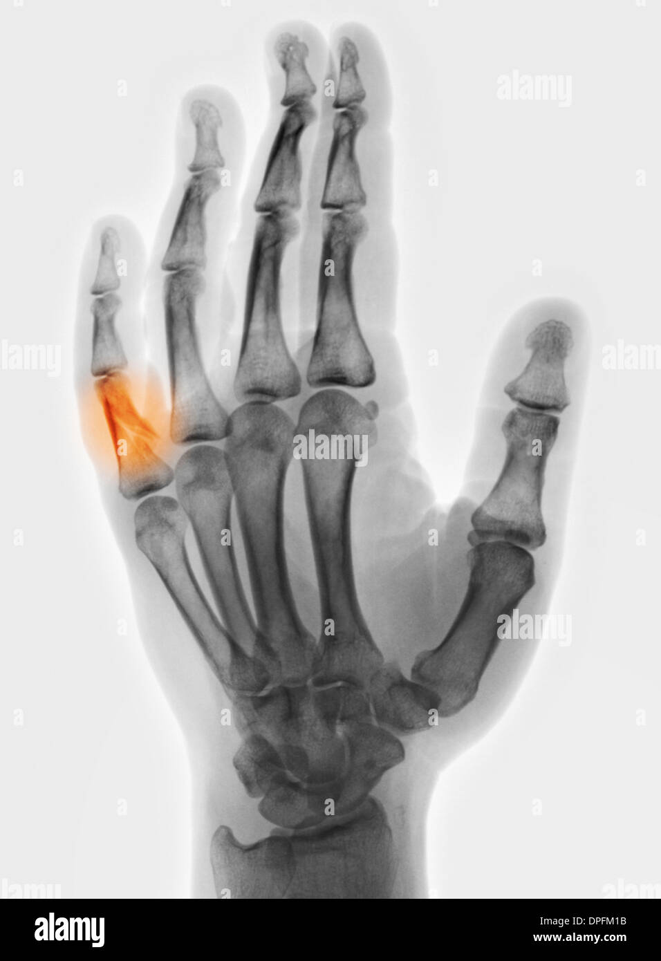 Röntgenaufnahme der Hand mit Fraktur des proximalen phalanx Stockfoto