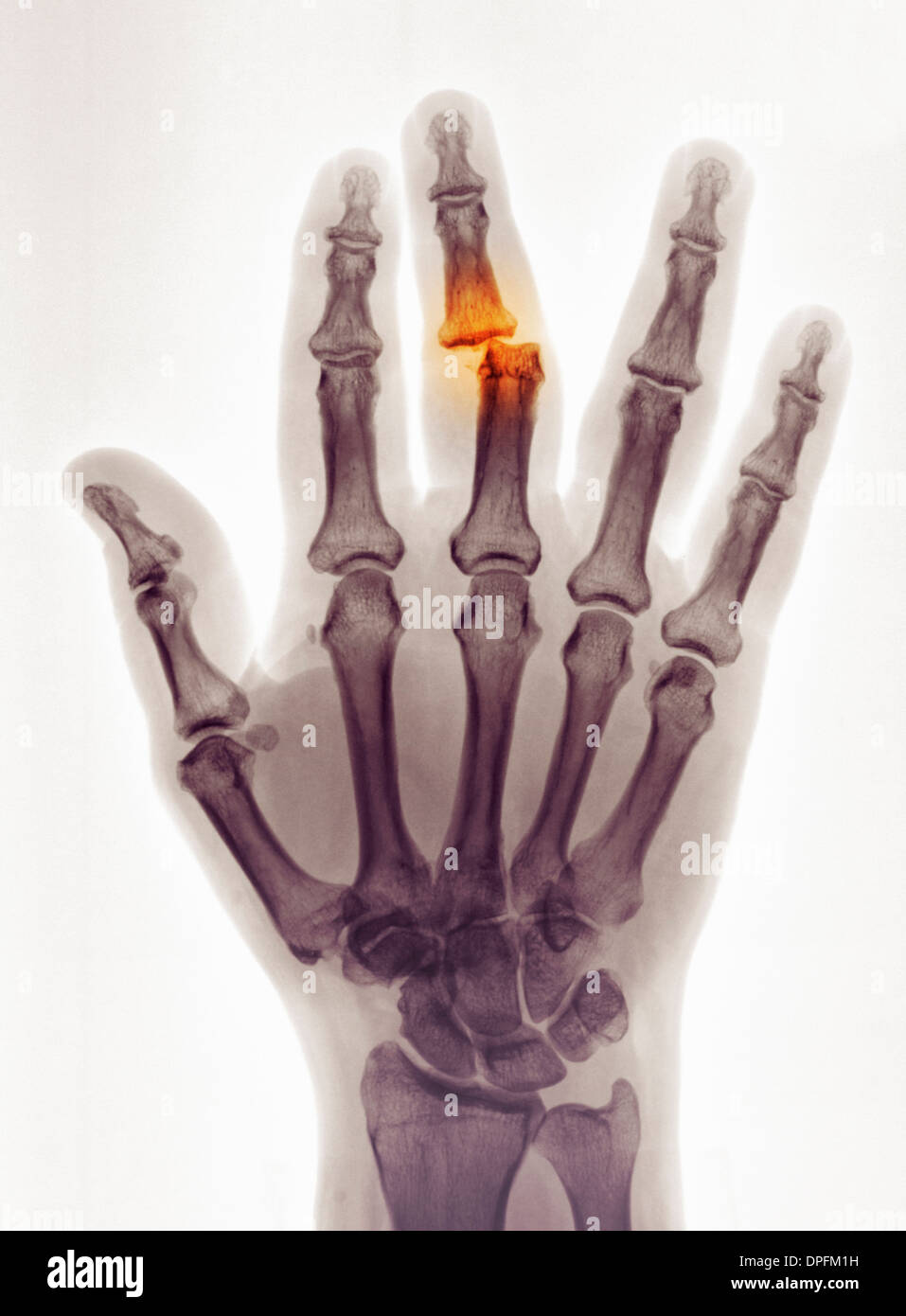 Hand-Röntgenaufnahme zeigt eine Luxation Stockfoto