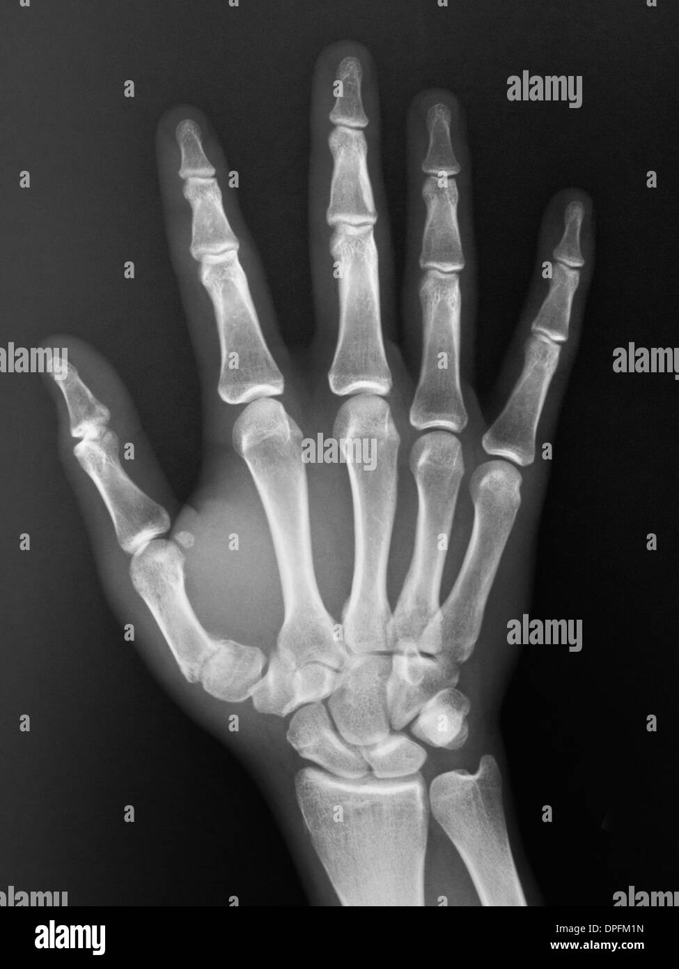normale Hand Röntgen eines 19-jährigen Jungen Stockfoto