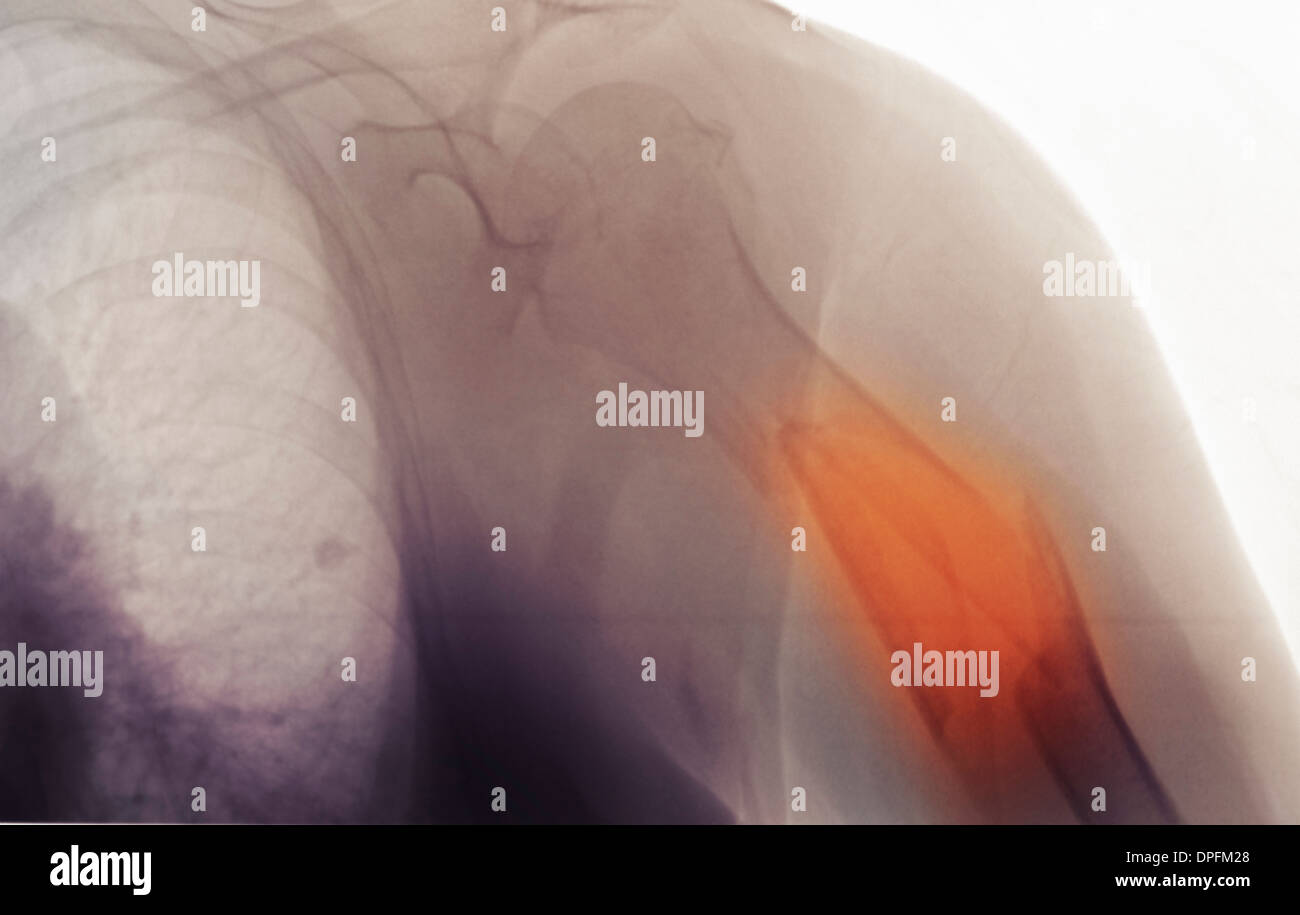 x-ray zeigt einen Trümmerbruch des humerus Stockfoto