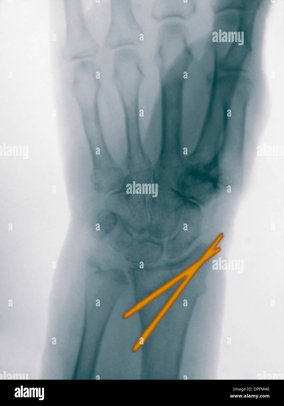 Röntgenbild einer Radius-Fraktur stabilisiert mit pins Stockfoto