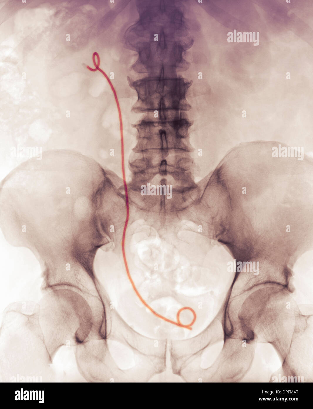 x-ray zeigt einen Harnleiter stent Stockfoto