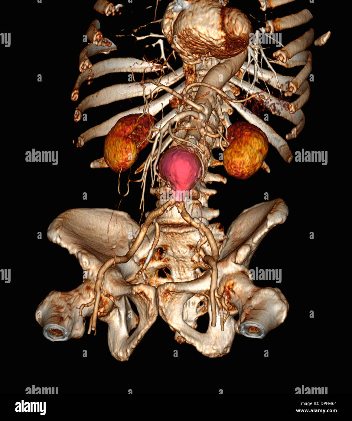 CT-Scan-Bild zeigt einen abdominalen Aortenaneurysma Stockfoto