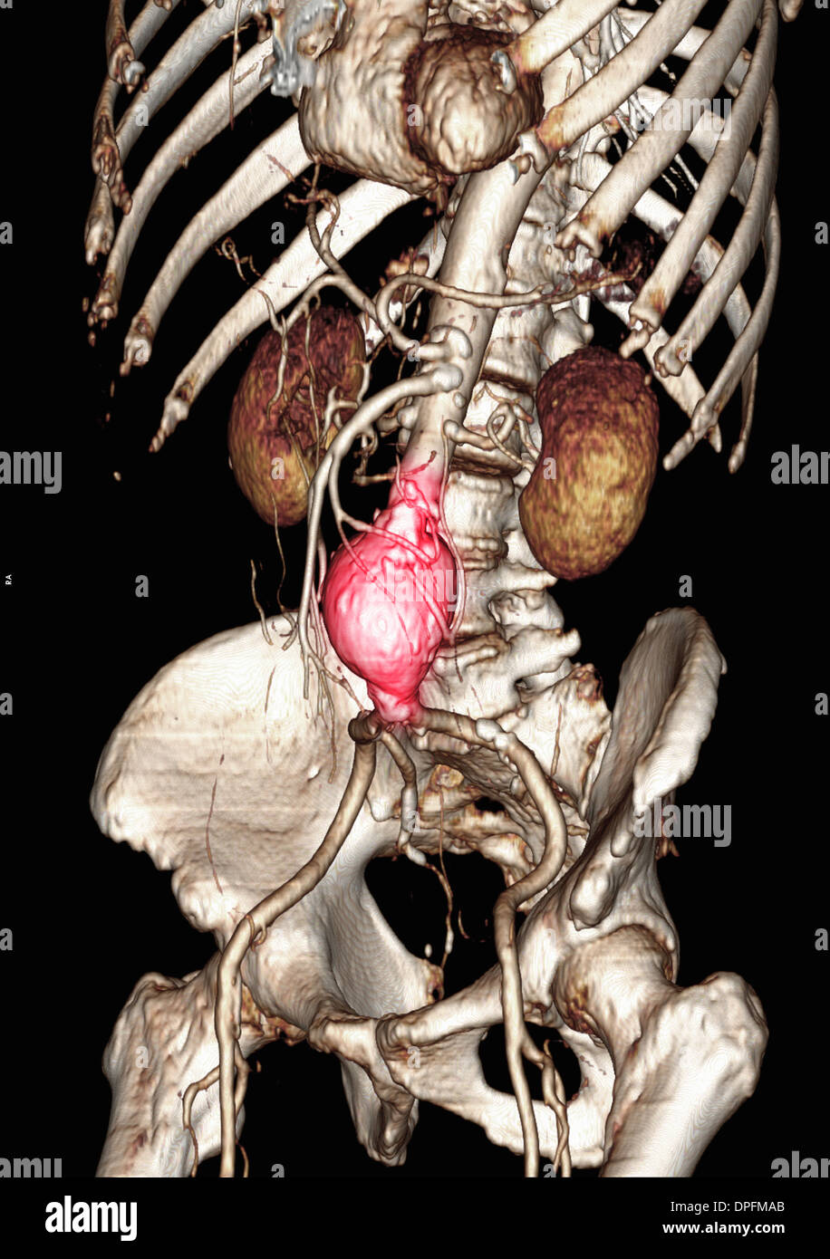 CT-Scan-Bild zeigt einen abdominalen Aortenaneurysma Stockfoto