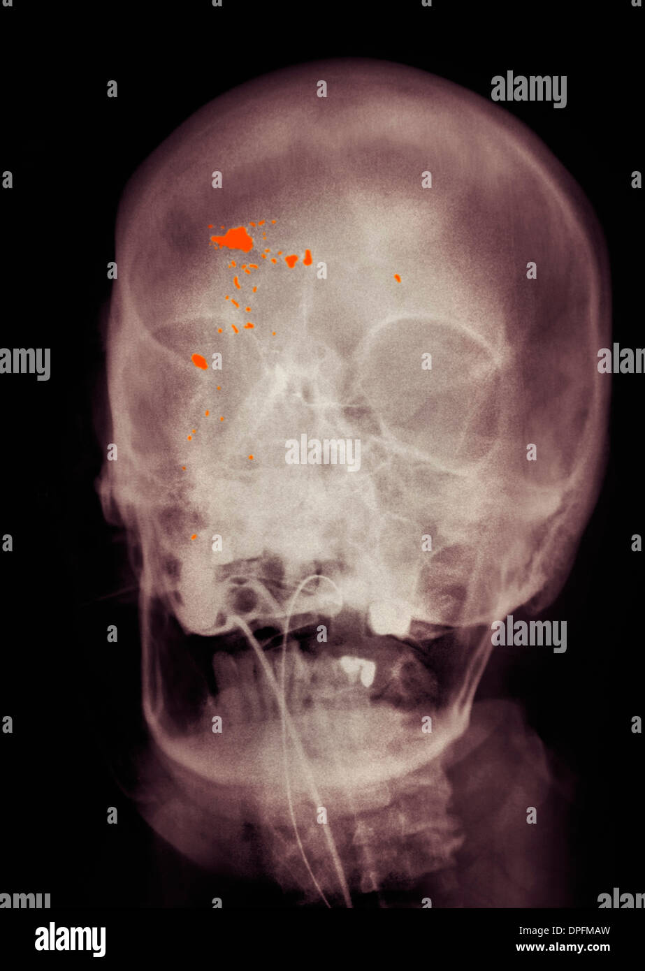 Eingefärbte Röntgenbild des Schädels zeigt Schusswunde Stockfoto