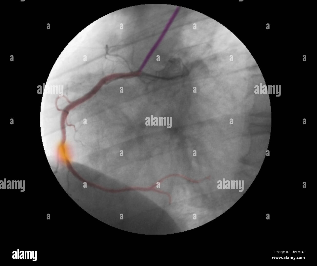 Angiogramm des RCA zeigt Stenose und Reparatur Stockfoto