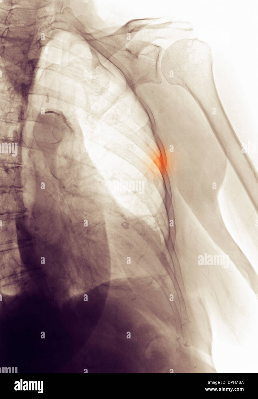X-ray zeigt Rippe Bruch Stockfoto