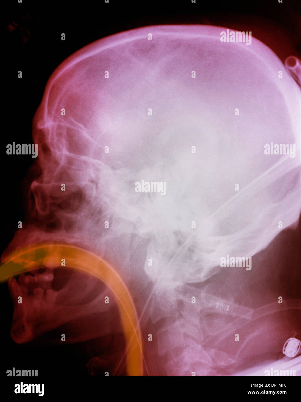 Röntgenbild des Schädels zeigt intubation Stockfoto