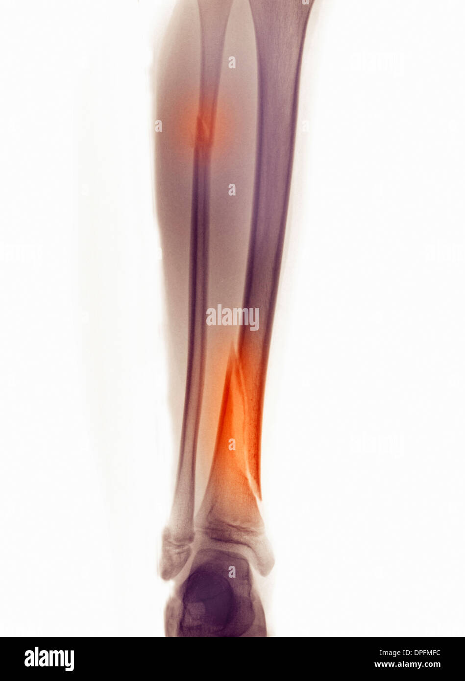 X-ray von Bein, Fraktur der Fibula und tibia Stockfoto