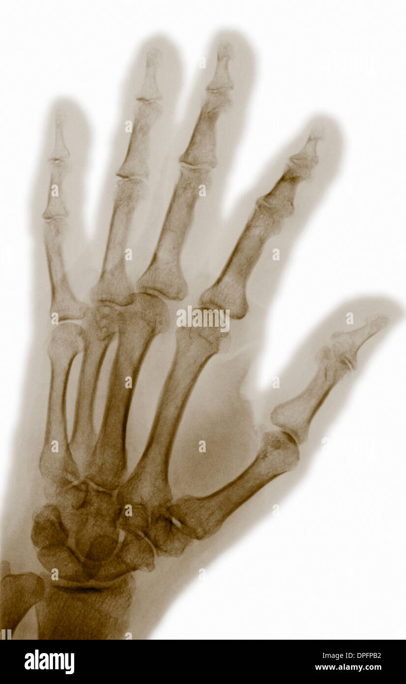Hand Röntgen zeigt milde Osteoporose Stockfoto