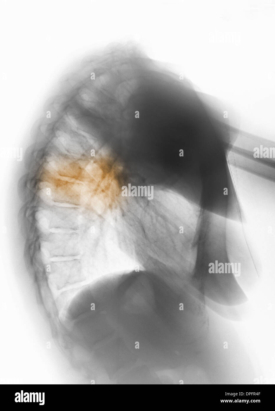 Röntgenuntersuchung der Brust zeigen, Lungenentzündung Stockfoto