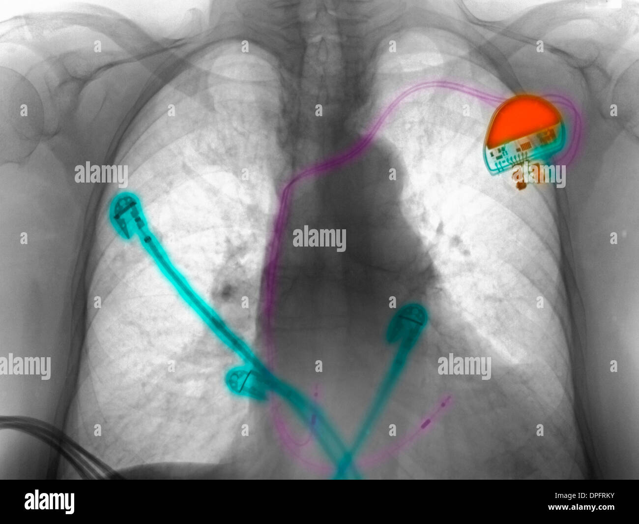 Röntgenaufnahme eines Herzschrittmachers Stockfoto