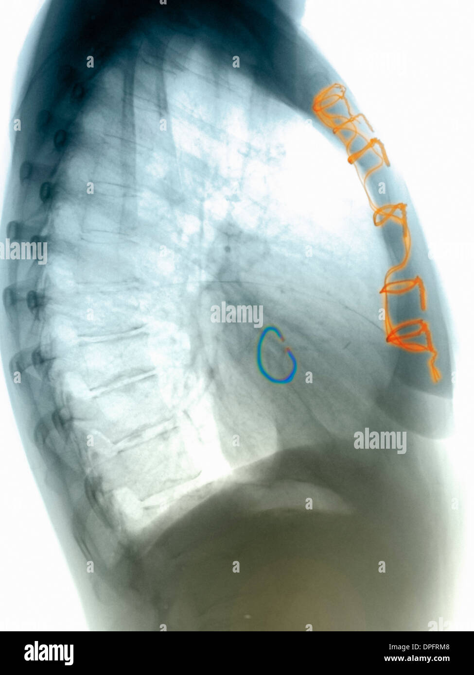 Röntgen-Thorax der Ersatz einer Herzklappe Stockfoto