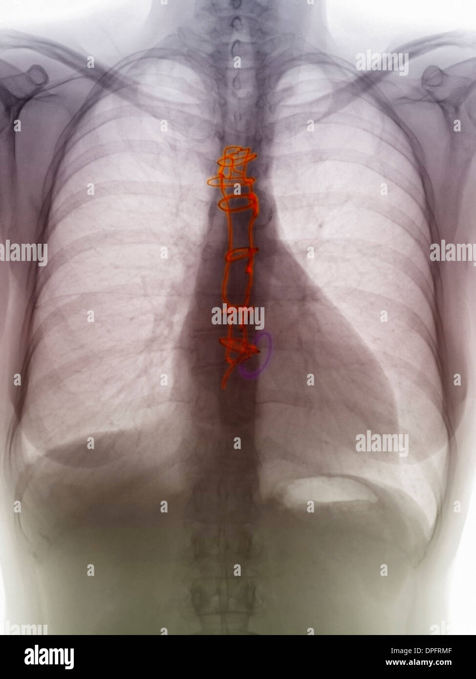 Röntgen-Thorax der Ersatz einer Herzklappe Stockfoto