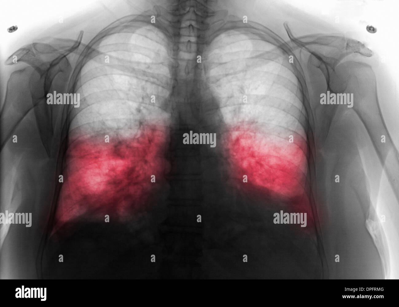 Brust Röntgen zeigt bilateraler Pneumonie Stockfoto