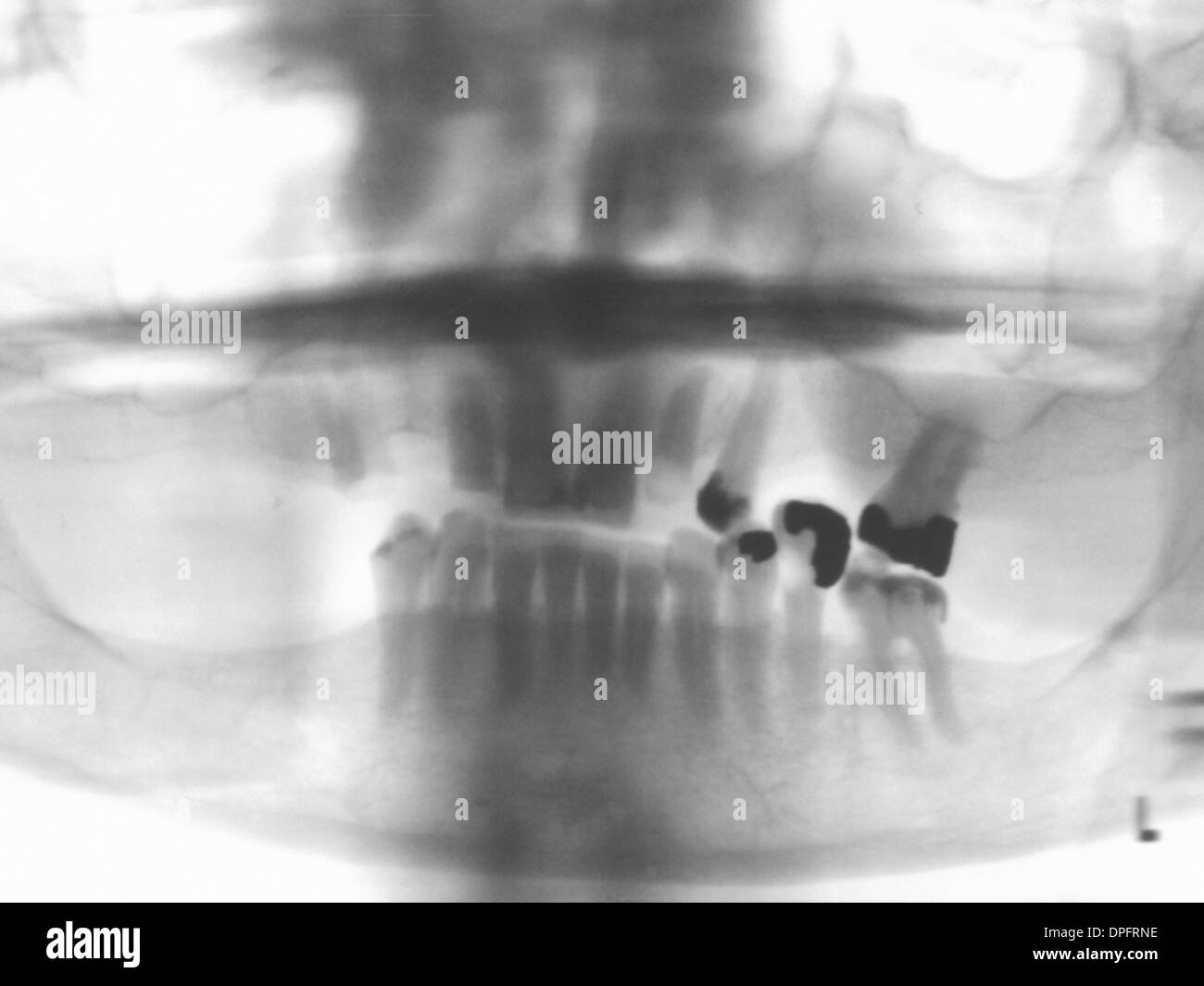x-ray zeigt Zahnfüllungen und fehlende Zähne Stockfoto