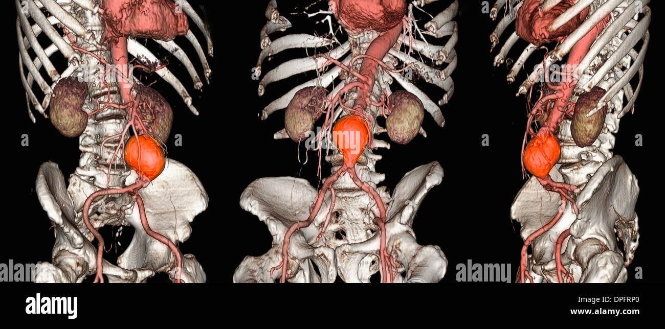 CT-Scan-Bilder von einem abdominalen Aortenaneurysma Stockfoto