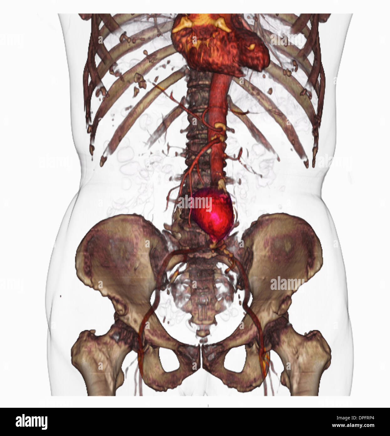 CT-Scan-Bild zeigt einen abdominalen Aortenaneurysma Stockfoto