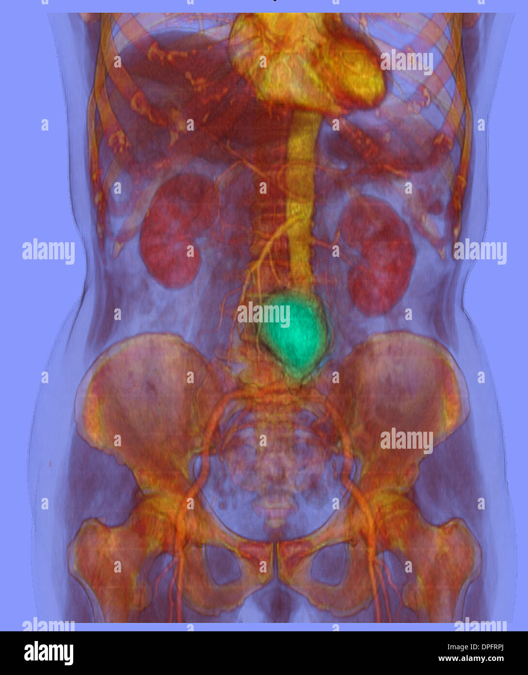 CT-Scan-Bild zeigt einen abdominalen Aortenaneurysma Stockfoto