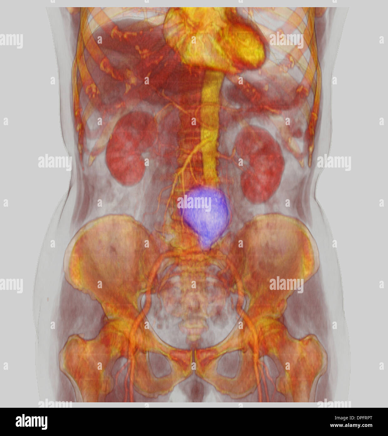 CT-Scan-Bild zeigt einen abdominalen Aortenaneurysma Stockfoto