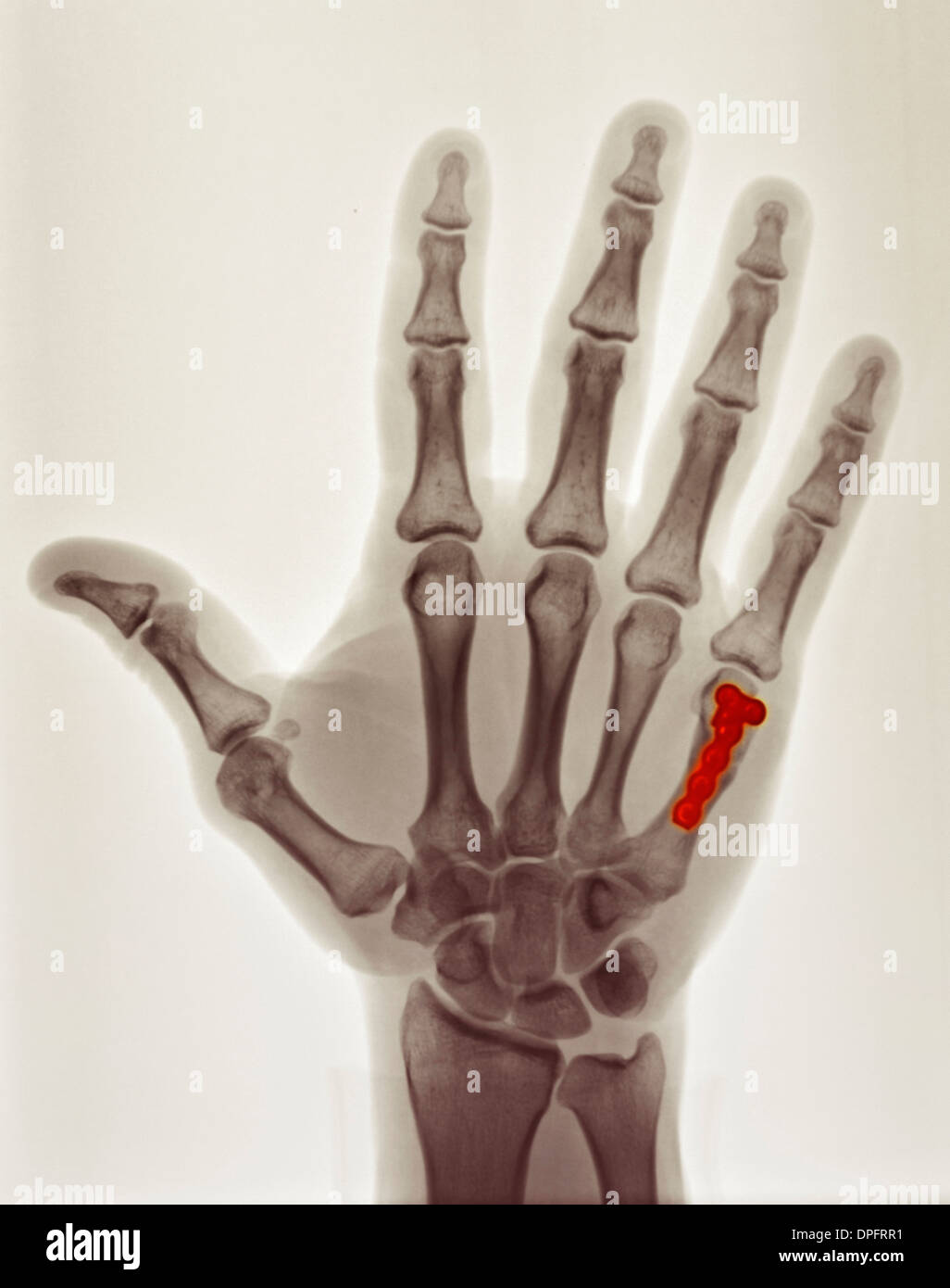 eingefärbte Röntgen zeigt Reparatur des Boxers Fraktur Stockfoto