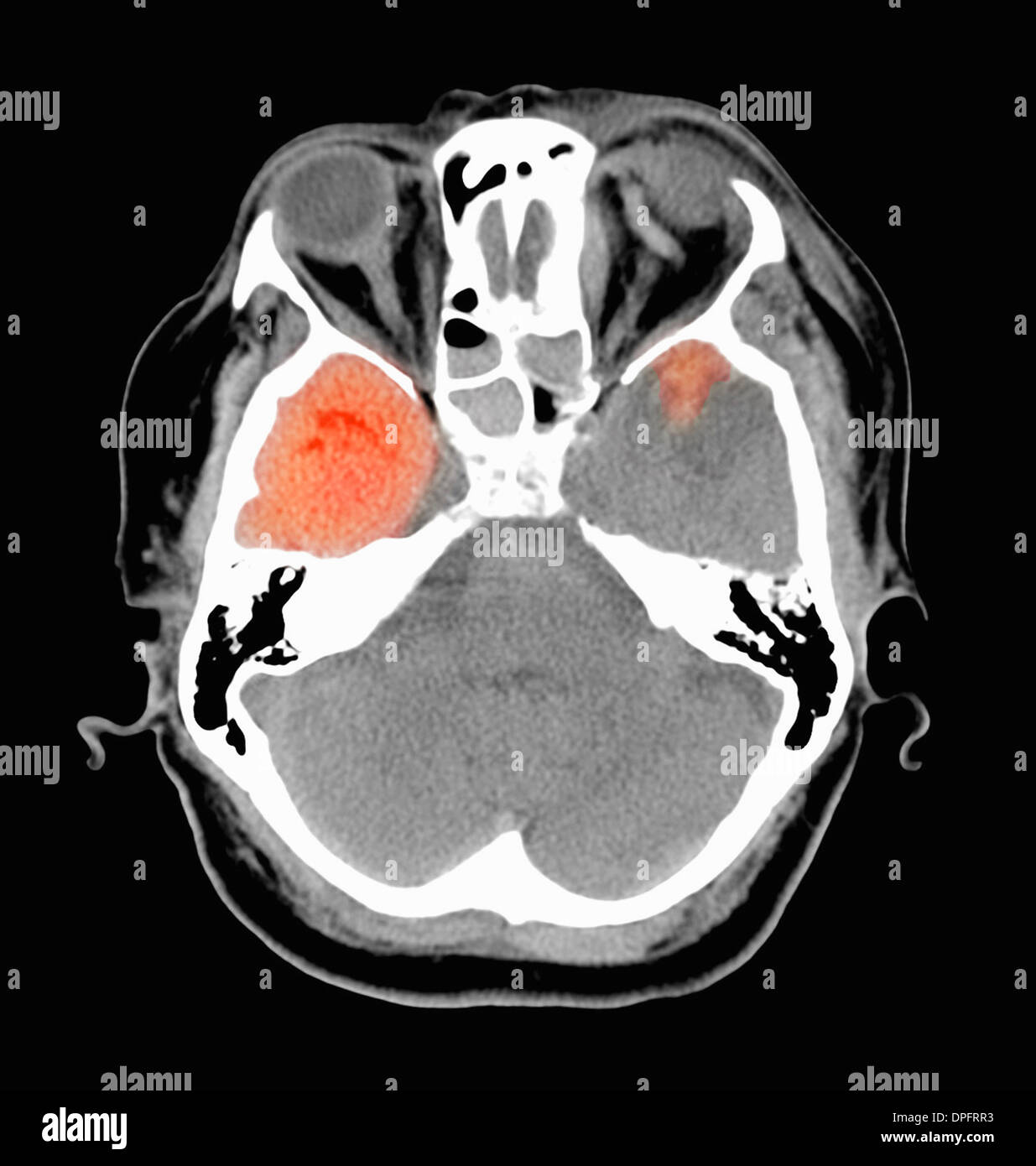 CT-Scan des Kopfes zeigt akute subdurale Hämatom Stockfoto