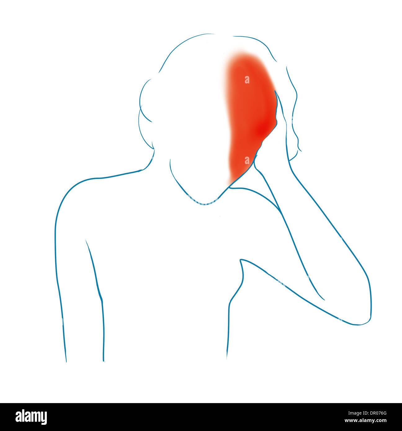 MIGRÄNE, ILLUSTRATION Stockfoto