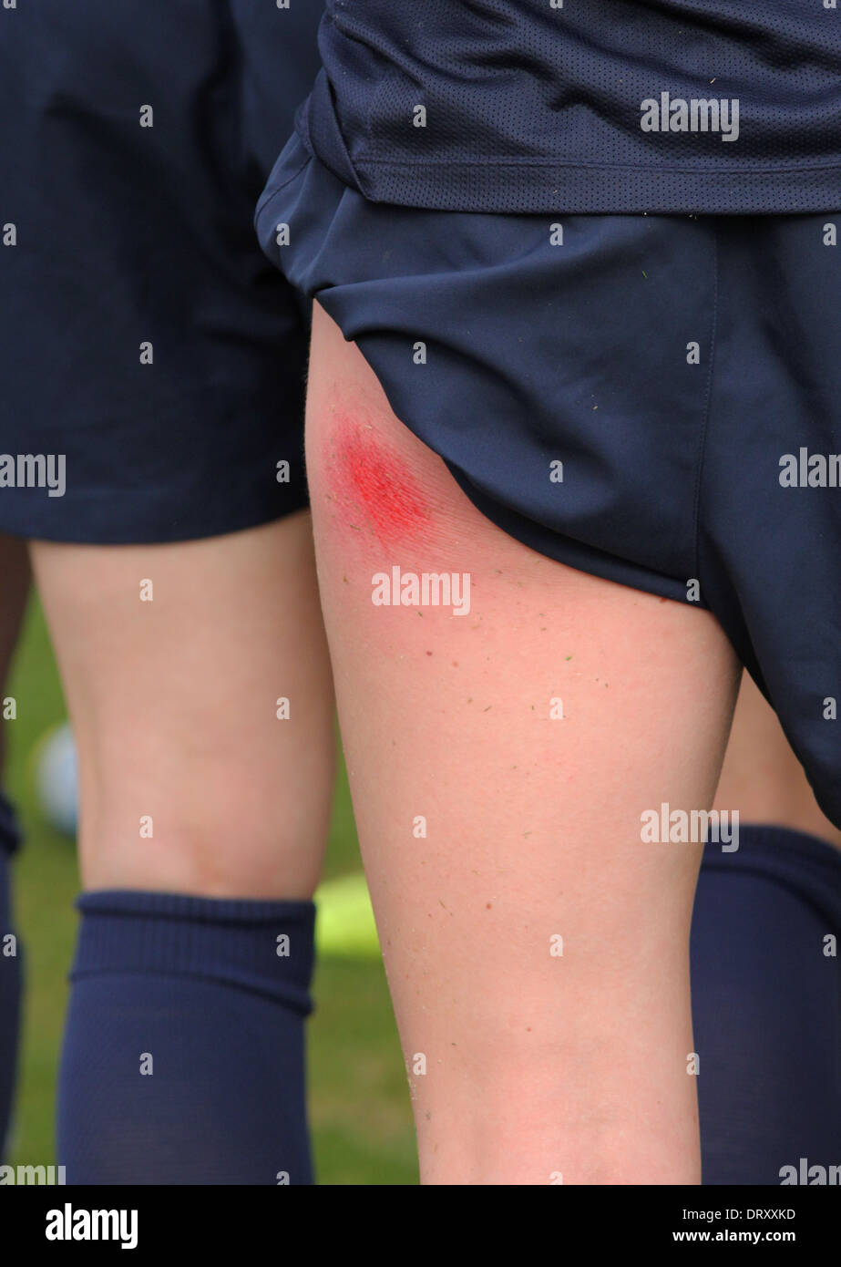 Sport Fußball Verletzungen Weiden Rasen brennen Stockfoto