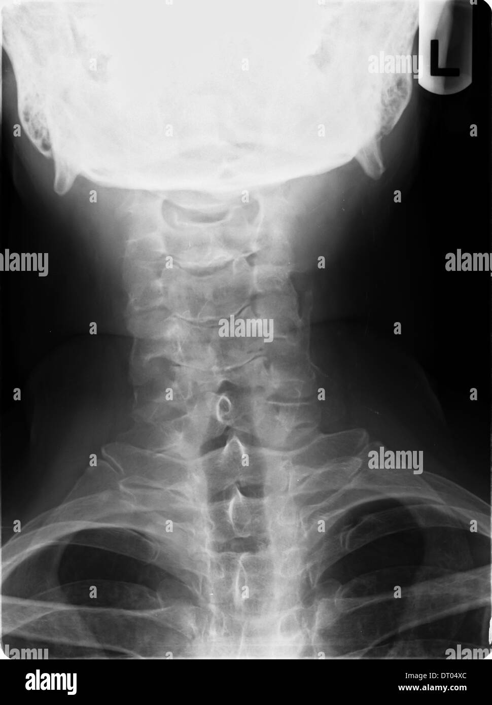 Röntgen des menschlichen Halses zeigt Wirbelsäule Wirbel Stockfoto