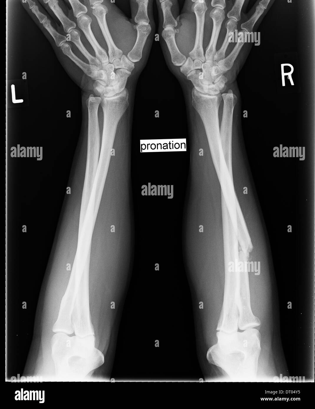 Vergleichende Röntgen des menschlichen Unterarme zeigt Fraktur des Knochens direkt radial in pronation Stockfoto