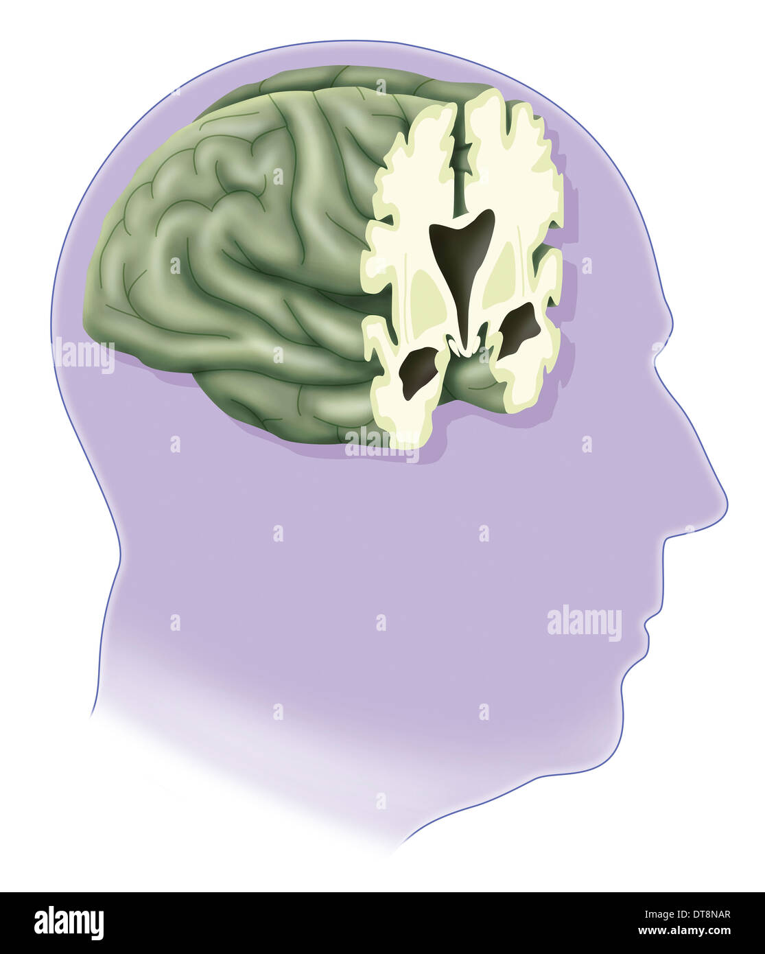 ALZHEIMER-KRANKHEIT, ZEICHNUNG Stockfoto