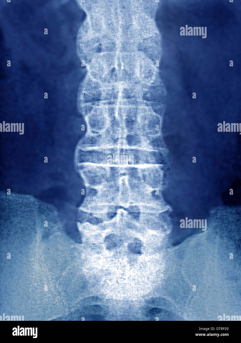MORBUS BECHTEREW, X-RAY Stockfoto, Bild: 66575768 - Alamy