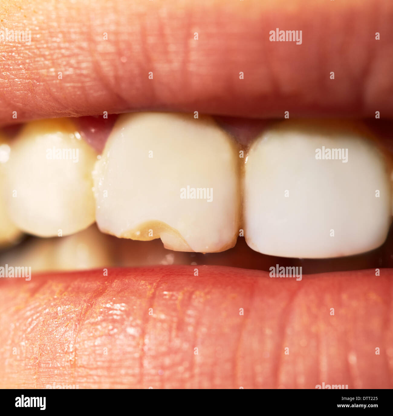 Broken teeth -Fotos und -Bildmaterial in hoher Auflösung – Alamy