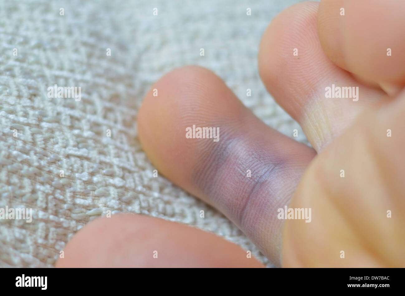 Verstauchten Fuß, linker Fuß Stockfoto