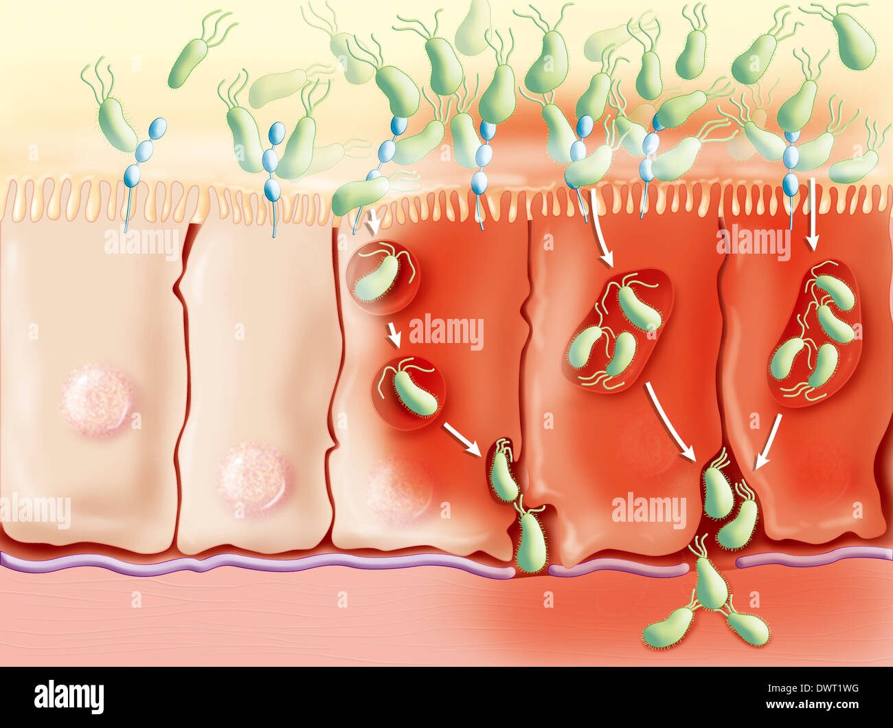 Morbus Crohn, Zeichnung Stockfoto