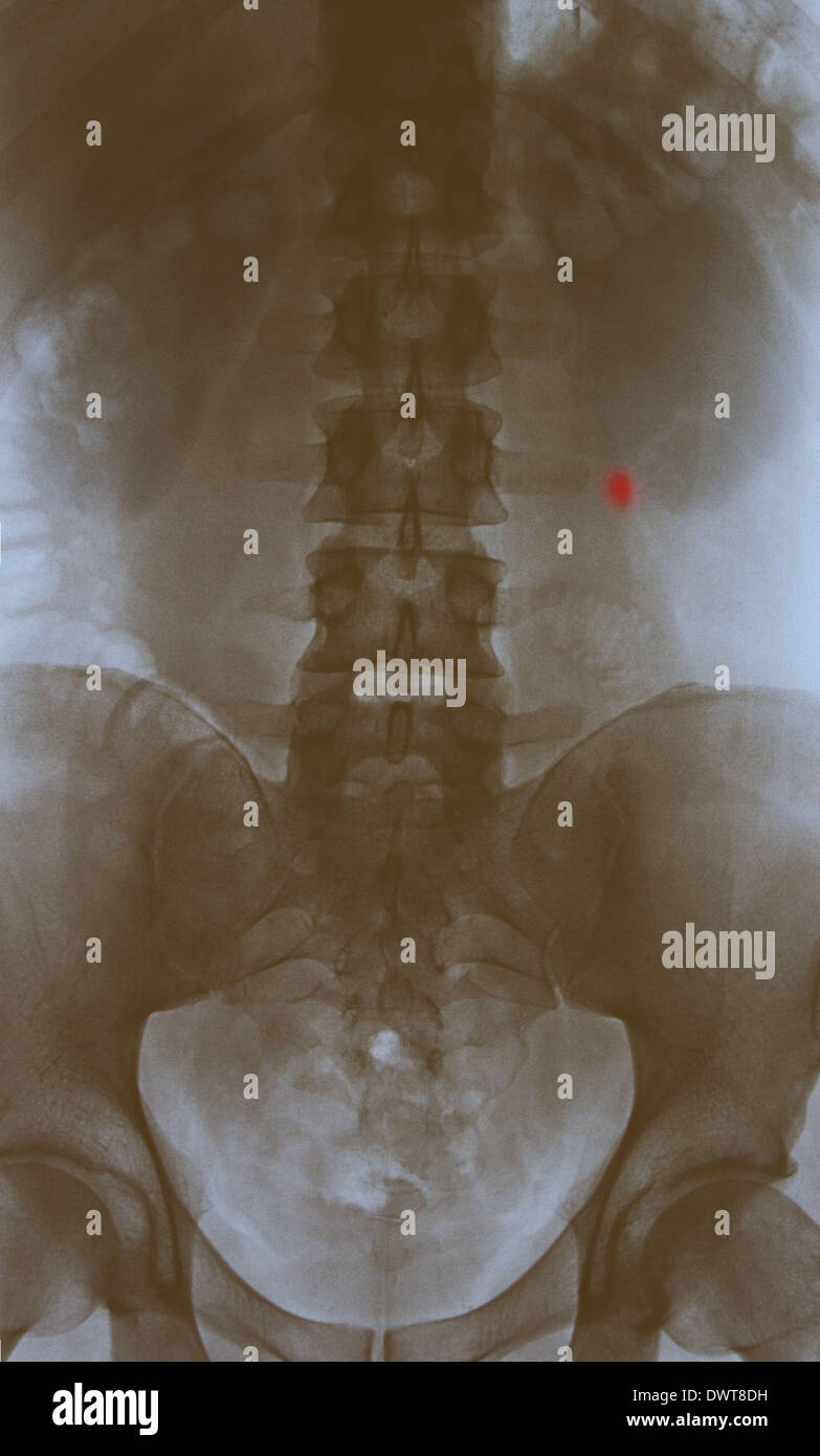 Nieren-Stein-X-ray Stockfoto