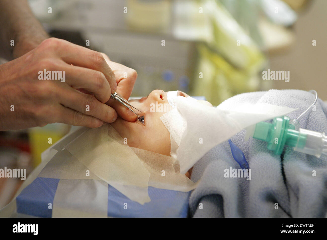 Kongenitale Glaukom Chirurgie Stockfoto