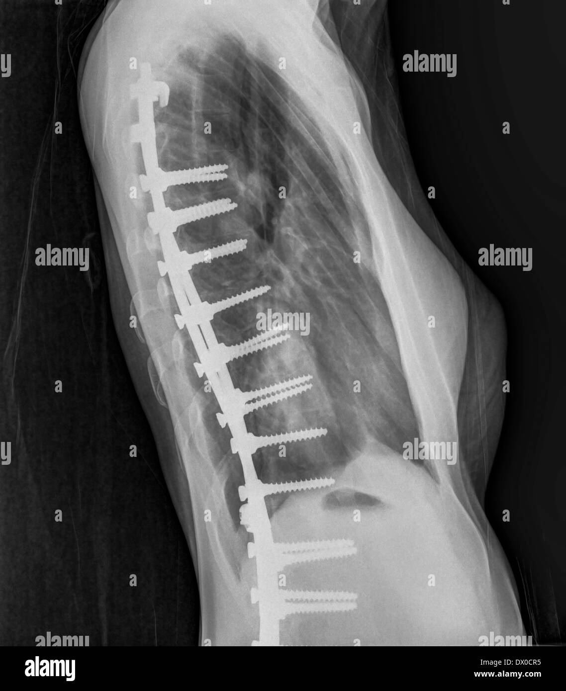 Spondylodese, auch bekannt als Spondylodese oder Spondylosyndesis, x-ray eine 16 Jahre alte weibliche Seitenansicht Stockfoto