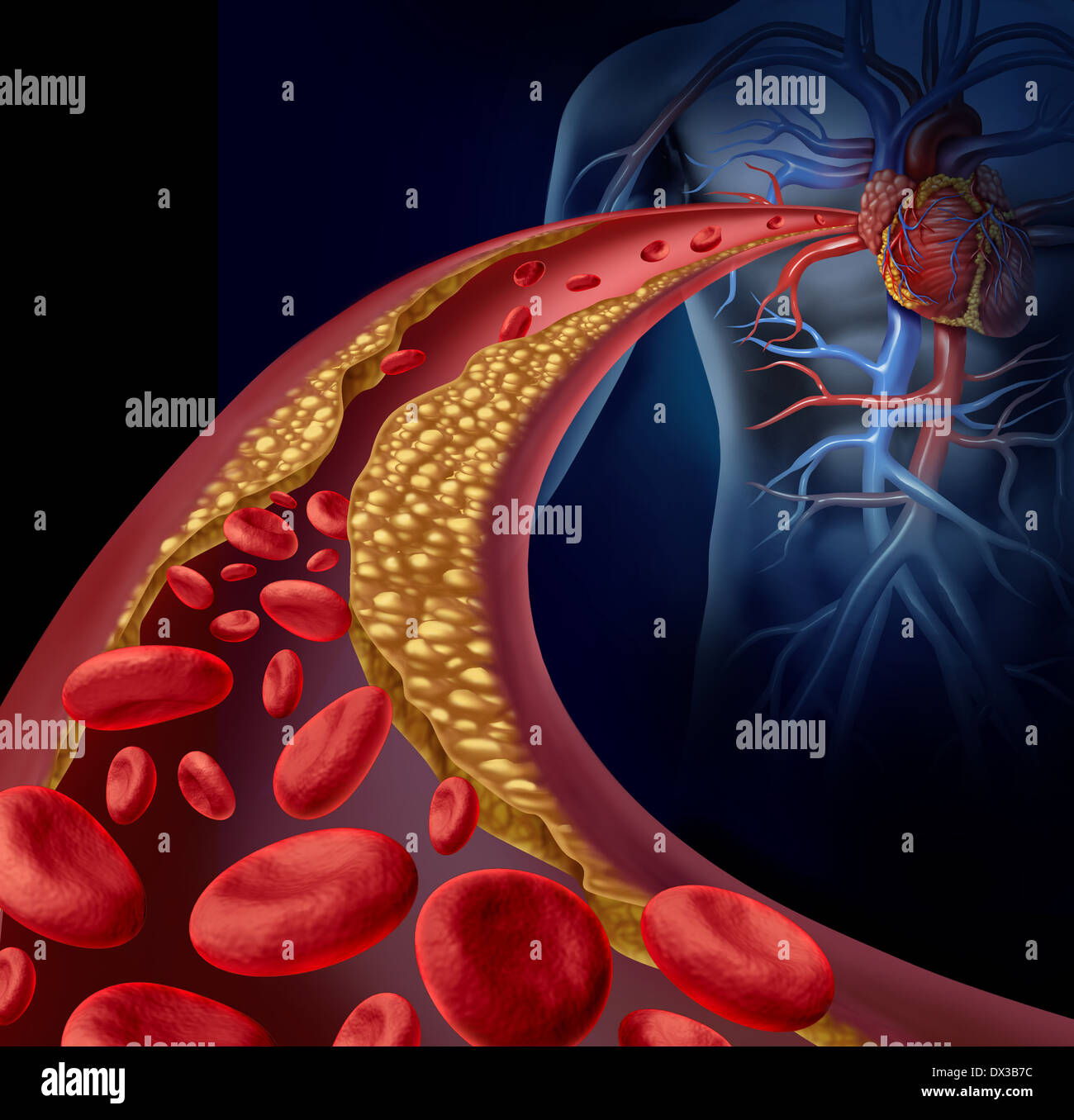 Verstopfte Arterie und Atherosklerose medizinische Krankheitskonzept mit drei dimensionale menschliche Arterie mit Blut Zellen, die als Symbol der arteriosklerotischer Gefäßerkrankungen durch Plaque-Bildung von Cholesterin blockiert ist. Stockfoto
