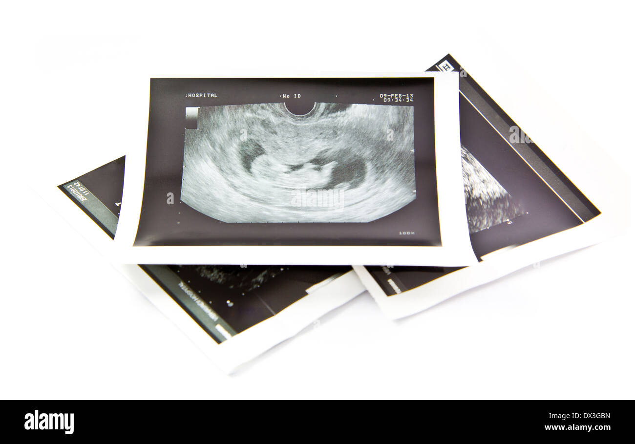 12 Wochen Baby Ultraschall Bild Stockfoto