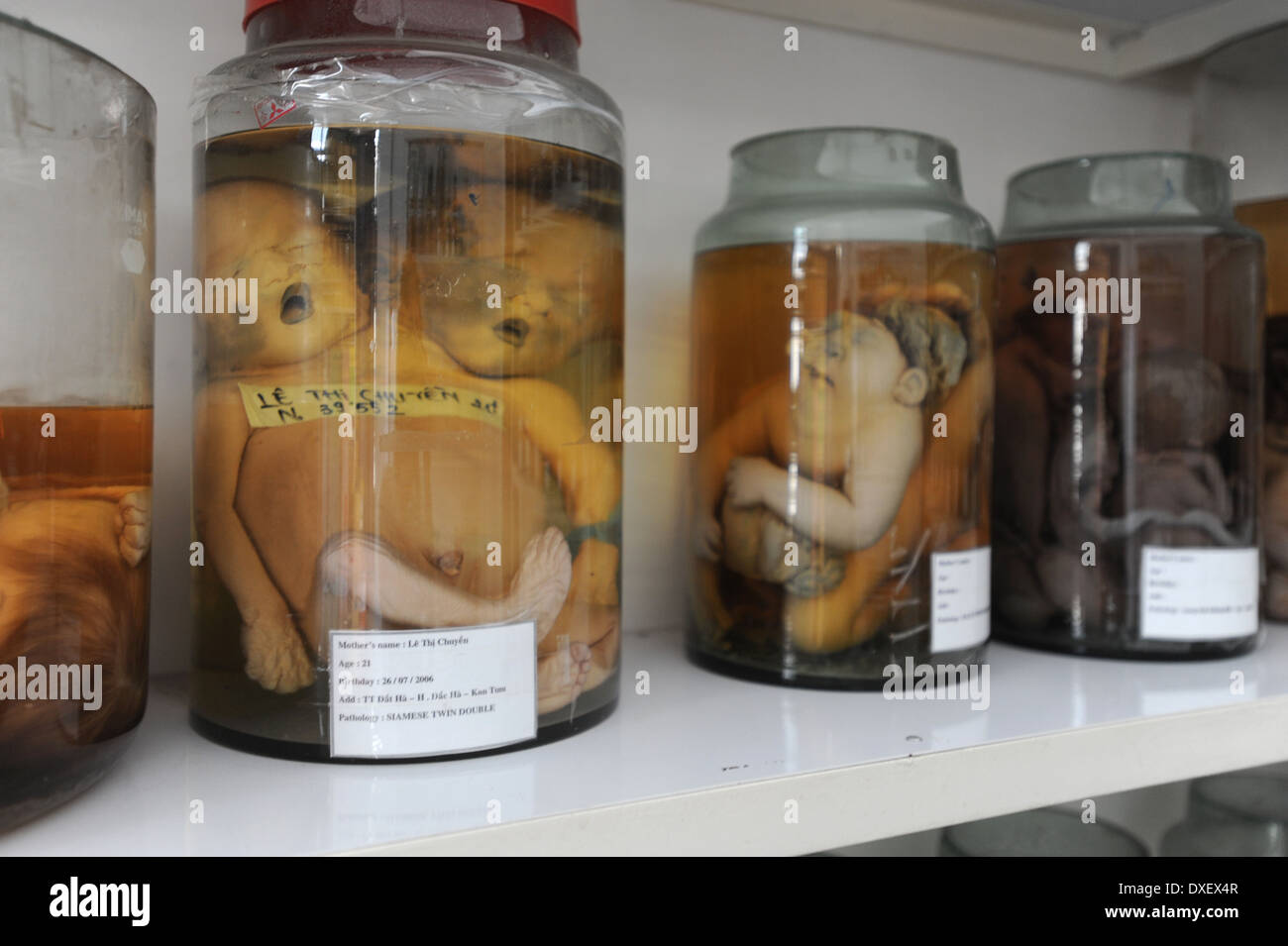 Gläser verformt, totgeborenen Föten von Agent Orange an der Tudu Hospital in Ho Chi Minh City, Vietnam verursacht. Stockfoto