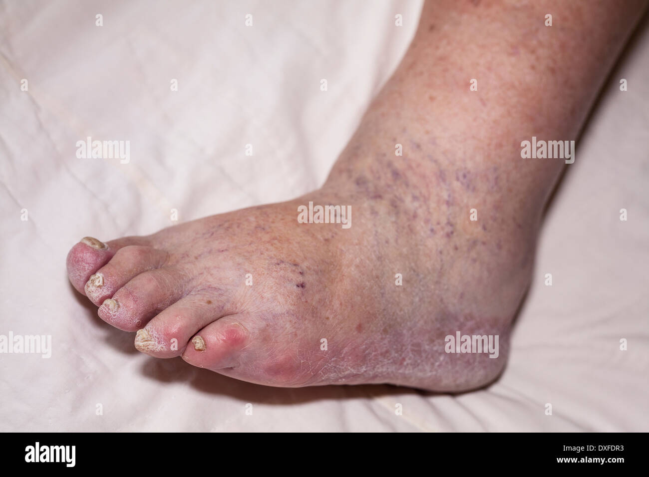Detail des Kranken senior weibliche geschwollene Bein mit beschädigten Zehen und Nägel. Stockfoto