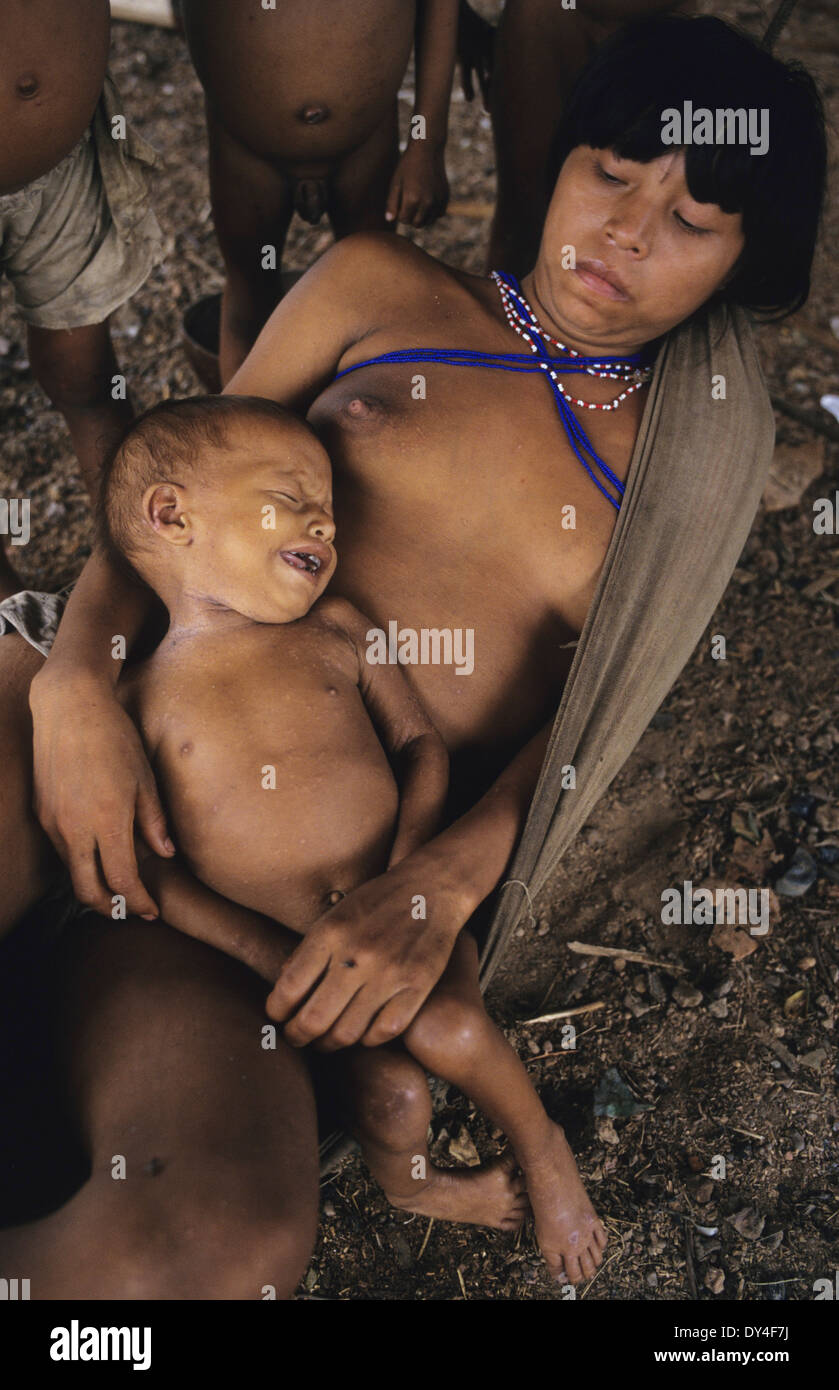 Malaria-Opfer leiden. Kind leidet an Malaria, Yanomami-Familie. Boa Vista, Roraima Provinz, Brasilien, Südamerika Stockfoto