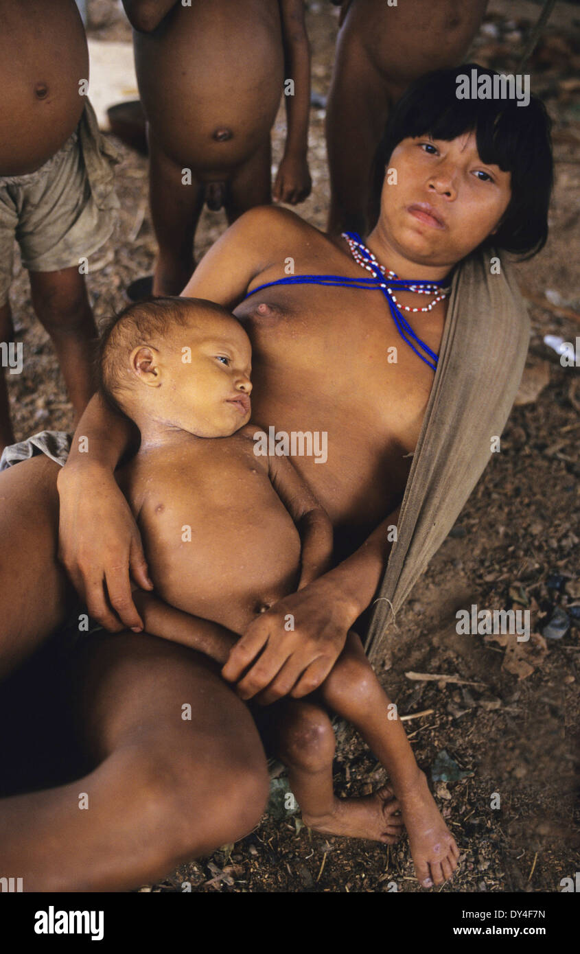 Malaria-Opfer leiden. Kind leidet an Malaria, Yanomami-Familie. Boa Vista, Roraima Provinz, Brasilien, Südamerika Stockfoto