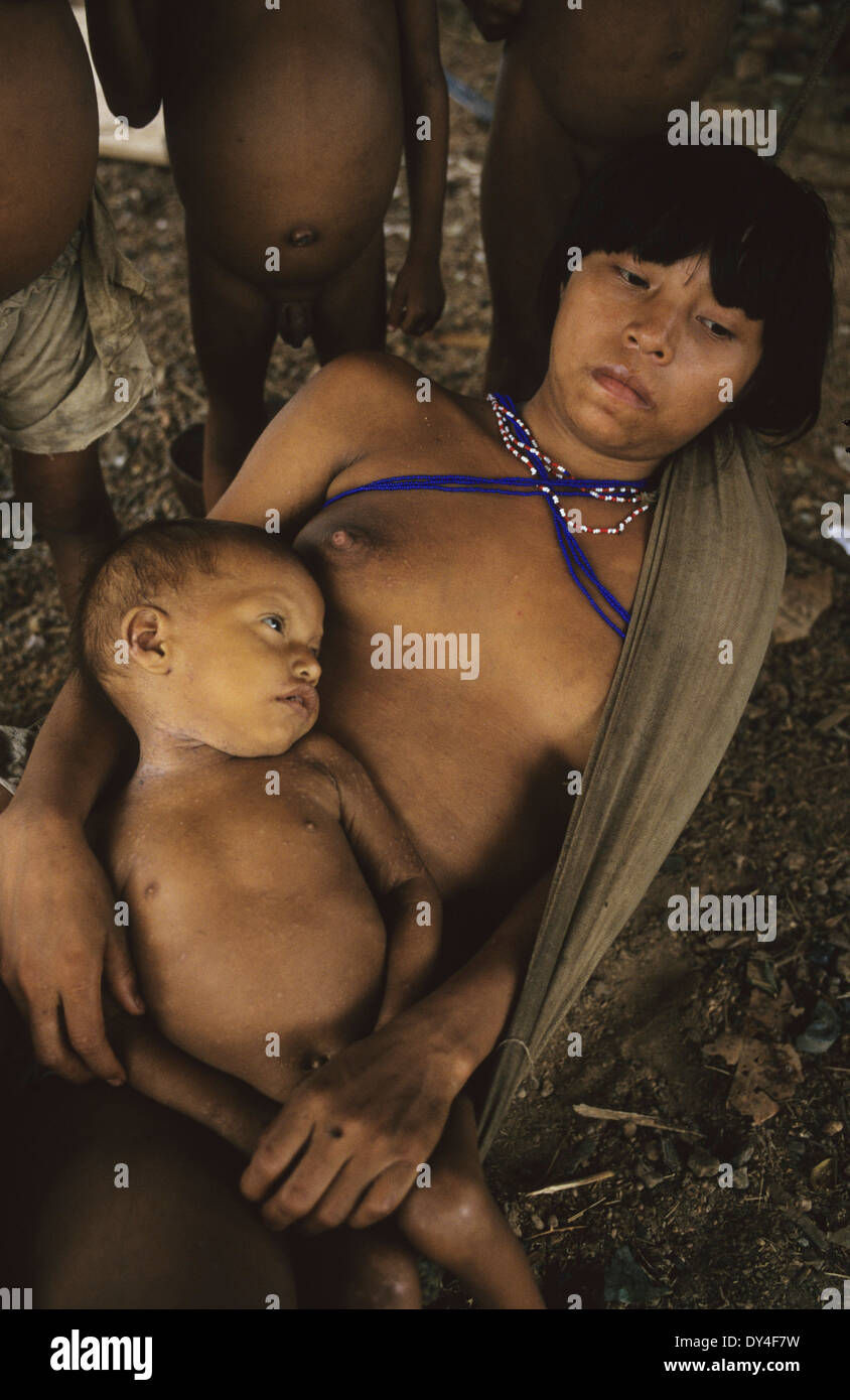 Malaria-Opfer leiden. Kind leidet an Malaria, Yanomami-Familie. Boa Vista, Roraima Provinz, Brasilien, Südamerika Stockfoto
