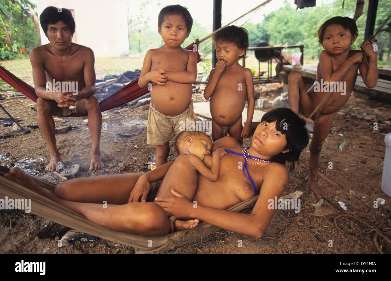 Malaria-Opfer leiden. Kind leidet an Malaria, Yanomami-Familie. Boa Vista, Roraima Provinz, Brasilien, Südamerika Stockfoto