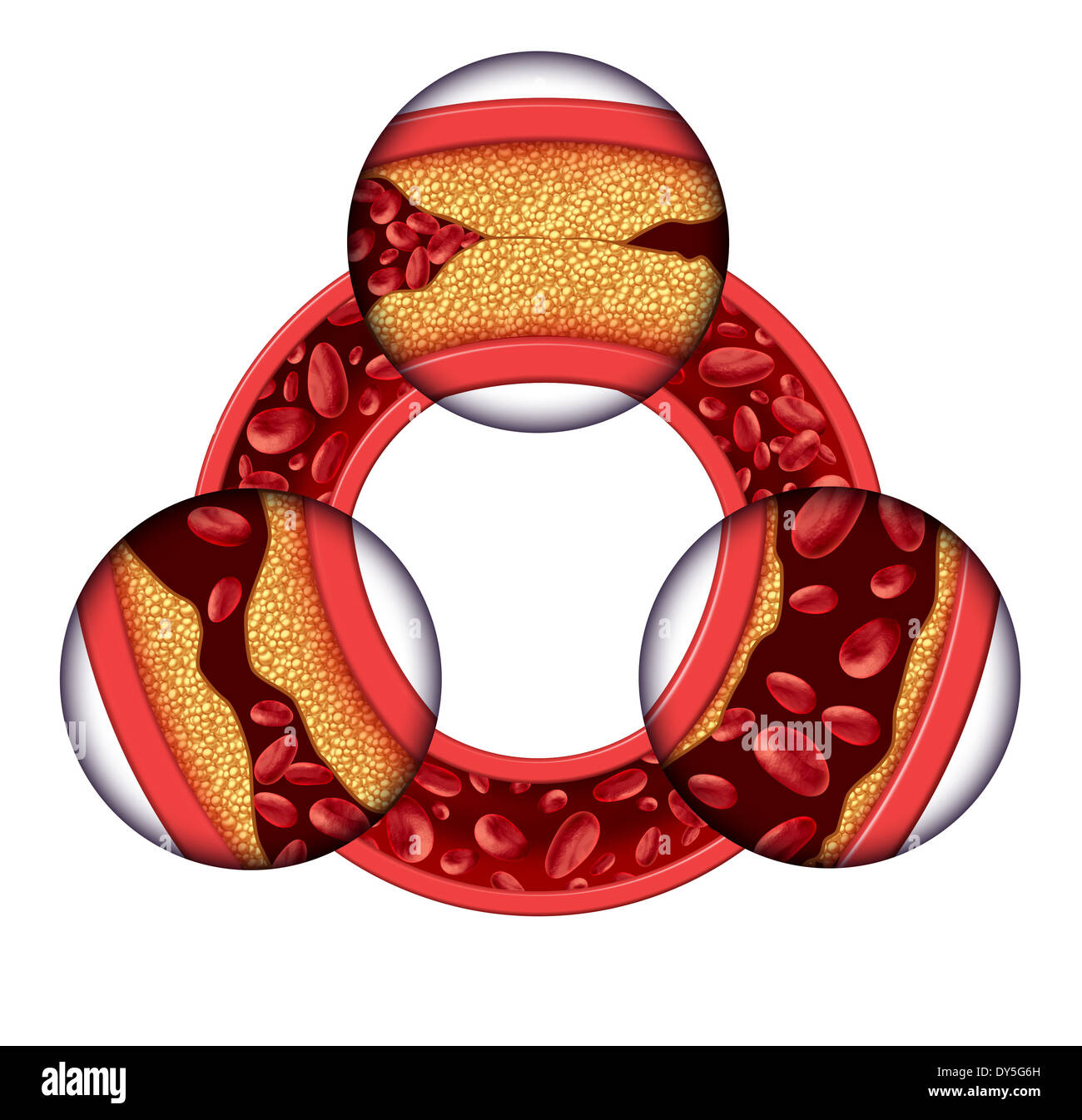 Koronare Erkrankungen medizinisches Konzept als eine kreisförmige Vene mit schrittweisen Plaquebildung, was zu verstopften Arterien und Atherosklerose mit mit drei dimensionale menschliche Anatomie das Diagramm zeigt die Risiken der Cholesterin-Ablagerungen. Stockfoto