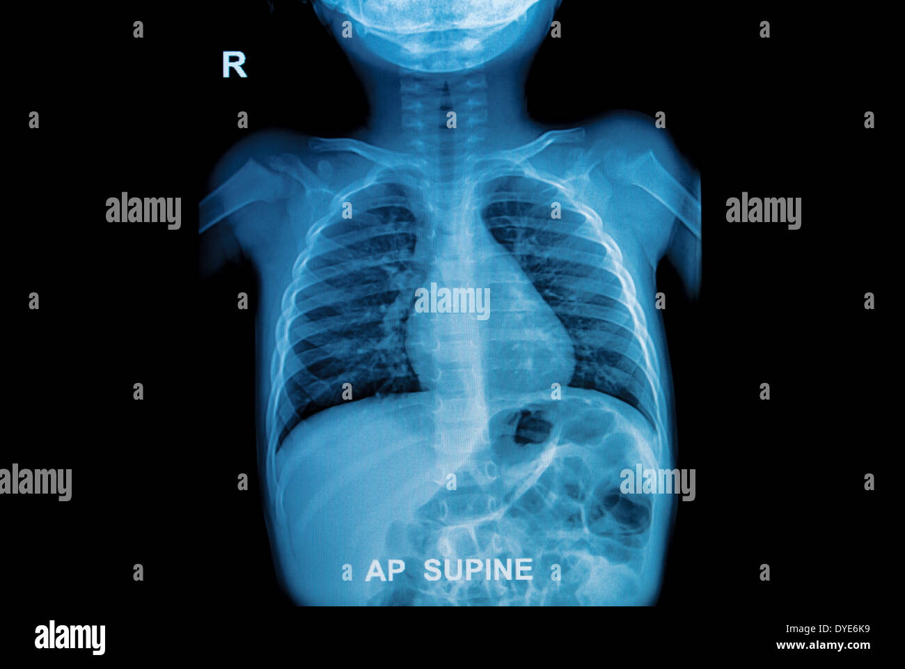 Röntgen-Thorax von Kindern Stockfotografie - Alamy