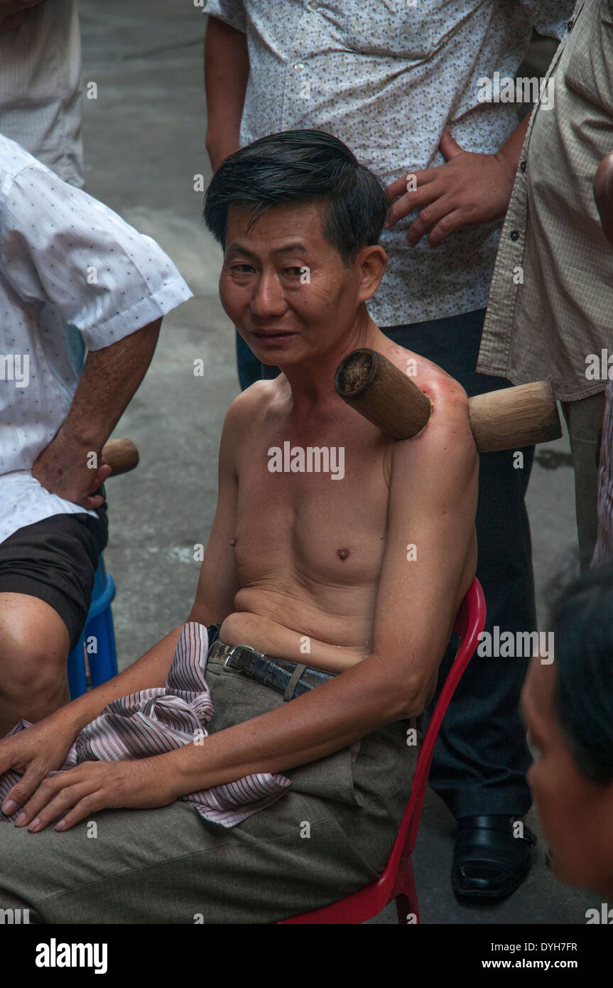 Demonstration der traditionellen Schröpfen Behandlung in einer Gasse in Phnom Penh, Kambodscha Stockfoto