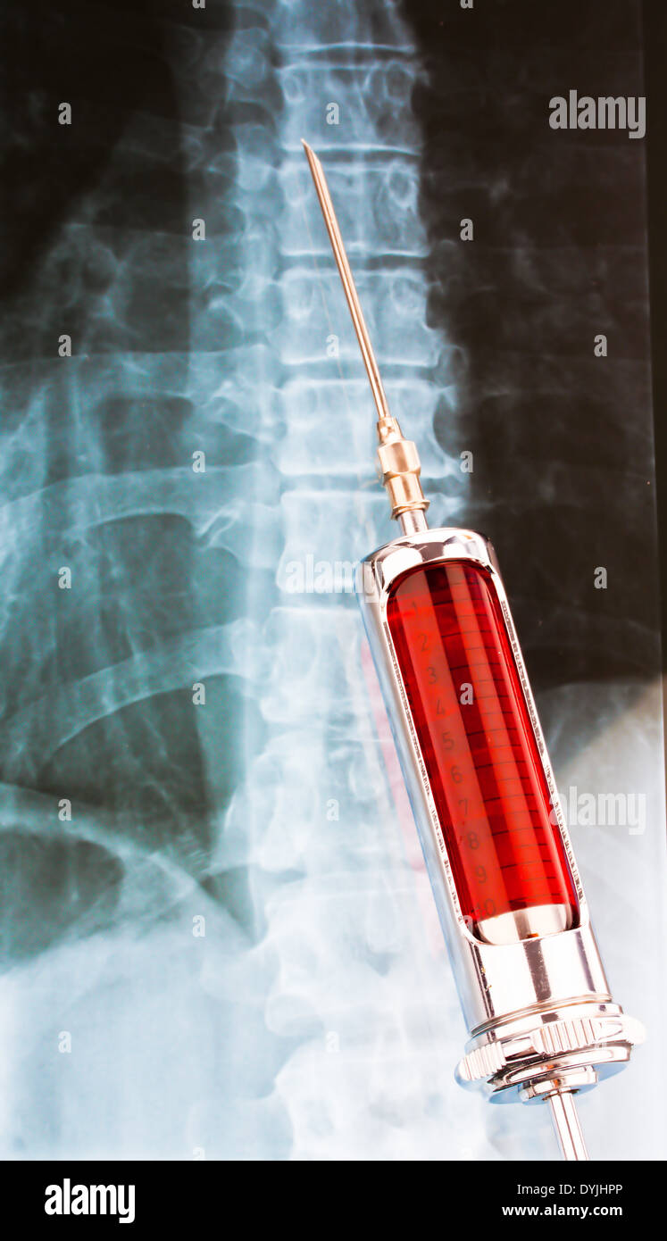Injektionsnadel Und Spritze Vor Einem Rˆntgenbild / Nadel und Spritze vor ein Röntgenbild, Spritze Vor Roentgenaufnahme Stockfoto
